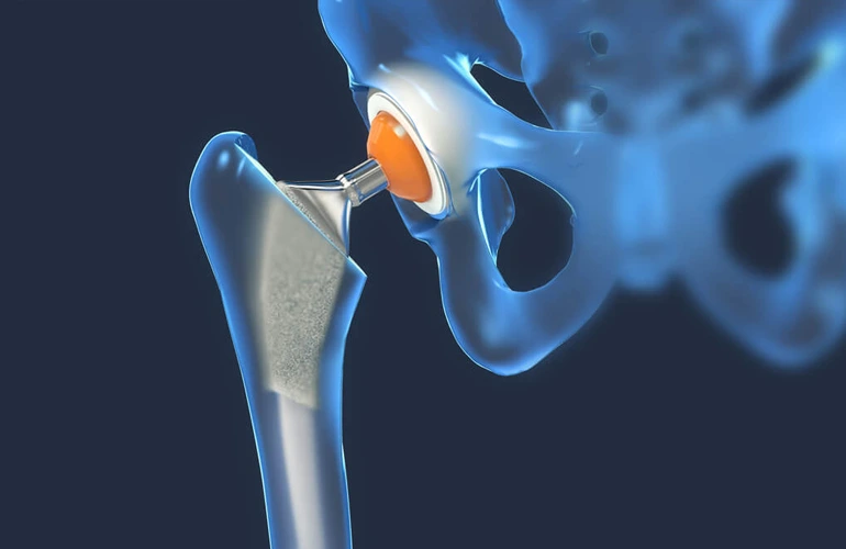primaryhipreplacement